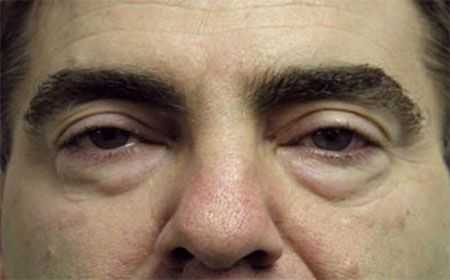 Tratamiento para eliminar las bolsas en los ojos con remedios naturales y sin cirugía