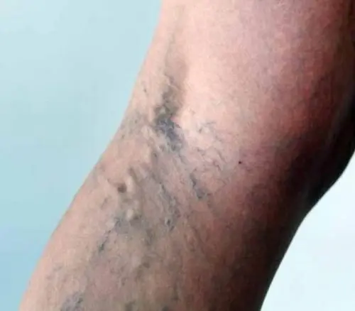 causas de las varices