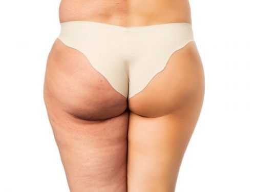 ¿Que es la celulitis?¿Cómo eliminar la celulitis sin tratamientos?