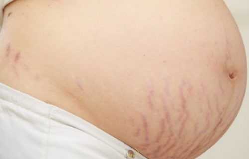 Eliminar las estrías: Guía definitiva para eliminarlas por completo