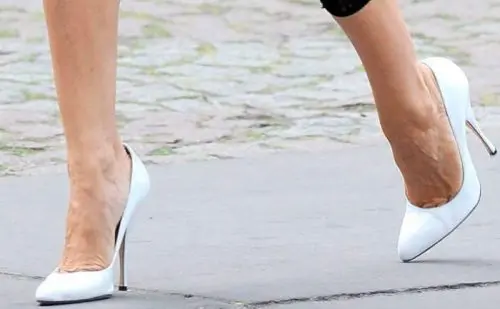 sintomas de las varices