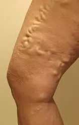 Eliminar las varices en las piernas