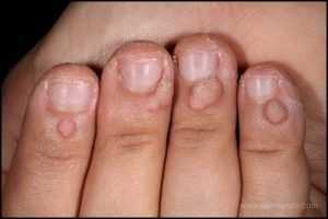 ¿Como eliminar las verrugas de tu piel? 2 verrugas