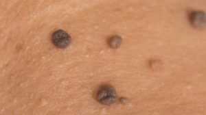 ¿Como eliminar las verrugas de tu piel? 3 eliminar Verrugas