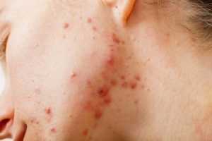 Conoce las propiedades de la arcilla beneficiosas para tu salud 7 acne