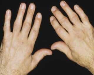Conoce las propiedades de la arcilla beneficiosas para tu salud 4 artritis