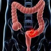 cancer colorrectal