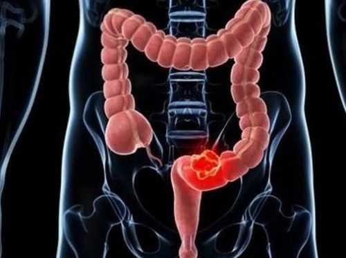 Cáncer de colon: Causas, diagnóstico y tratamiento