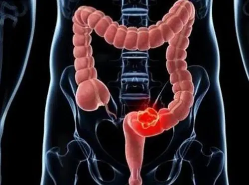 Cáncer de colon: Causas, diagnóstico y tratamiento 1 cancer colorrectal