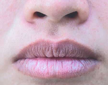 labios agrietados