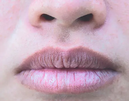 labios agrietados