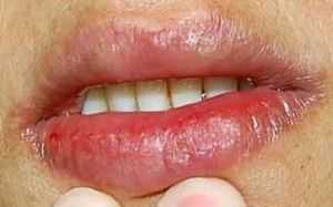 ¿Como quitar las grietas de los labios? 3 labios con grietas