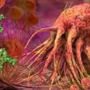 metastasis