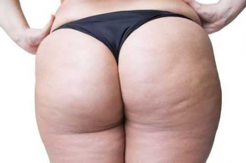 Excelentes remedios caseros que te ayudan a combatir la celulitis