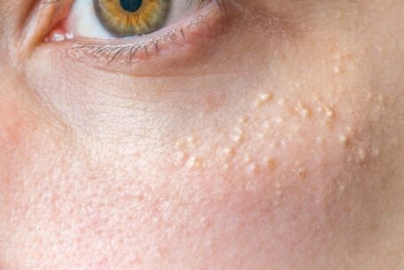 Evitar el acné es posible: Remedios naturales 1 El acne es uno de los problemas mas complicados a los que tienen que enfrentarse sobre todo los jovenes a nivel de cuidar su rostro.