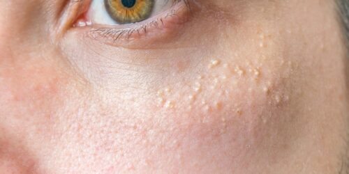 Evitar el acné es posible: Remedios naturales