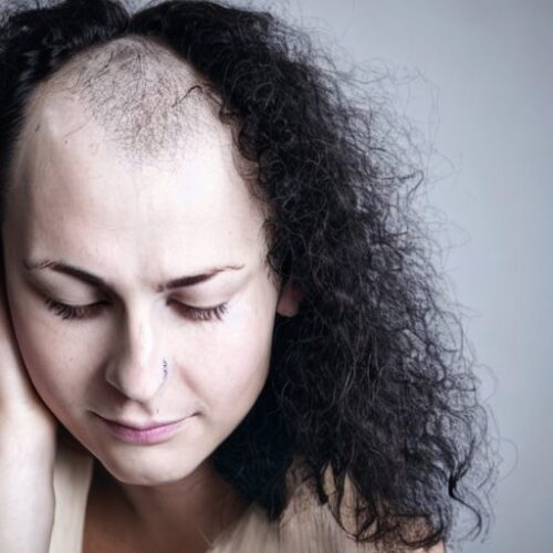 Cómo afecta la salud mental a la caída del cabello