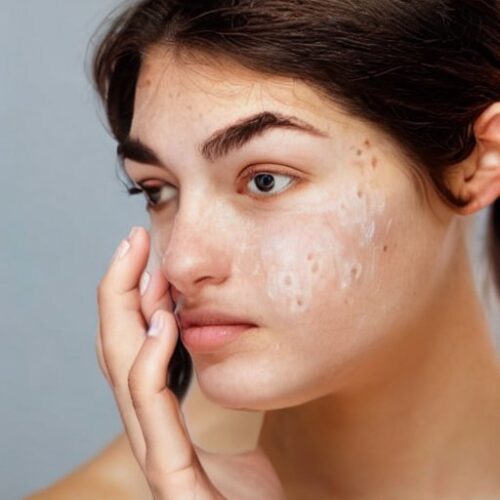 El acné: lo que necesitas saber
