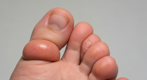 Close-up photorealistic image of a human foot showing dactylitis affecting two toes, with characteristic sausage-like swelling, visible inflammation and slight redness, against a neutral background, m