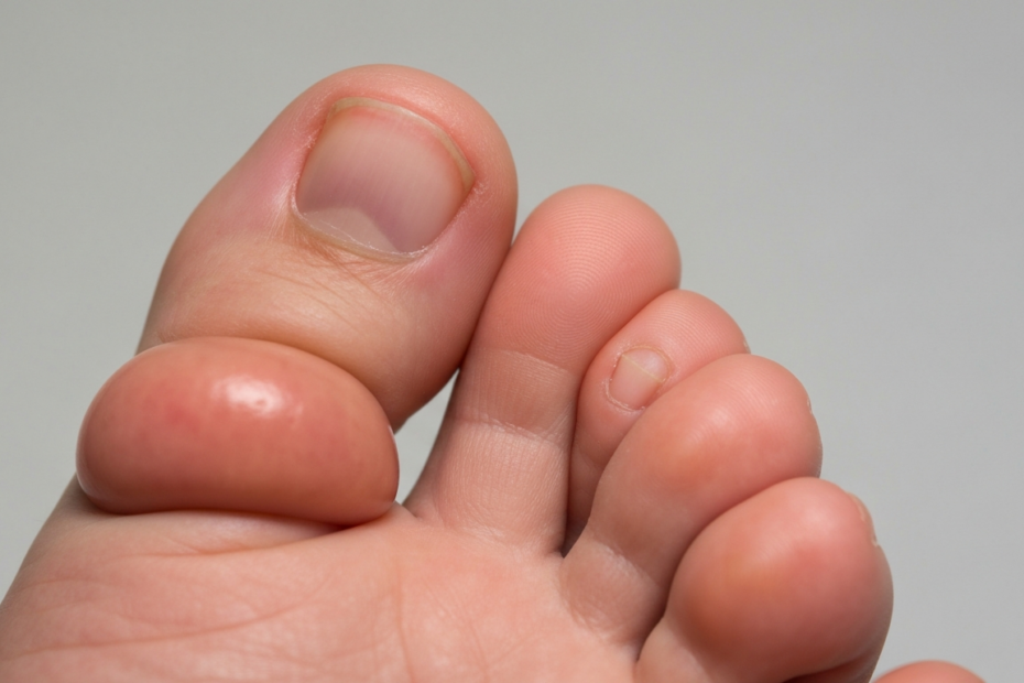 Close-up photorealistic image of a human foot showing dactylitis affecting two toes, with characteristic sausage-like swelling, visible inflammation and slight redness, against a neutral background, m