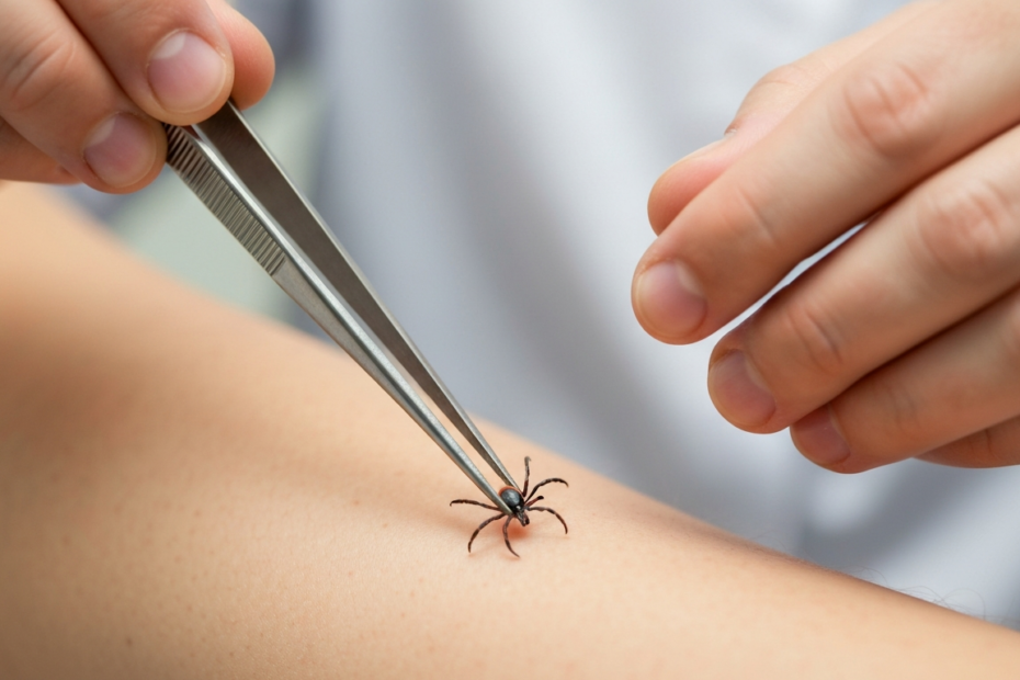 Guía completa tras picadura de garrapata: prevención y cuidados 1 Photorealistic close-up of a tick attached to human skin, with tweezers approaching it correctly, natural lighting, medical context, no text or logos.