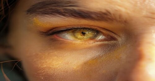 Close-up of a woman's eye area with a yellowish xanthelasma plaque near the inner corner, soft natural lighting, realistic skin texture, no makeup, serene expression.